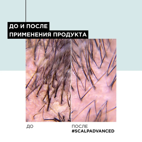 Шампунь от перхоти / SCALP ADVANCED 300 мл фото 6
